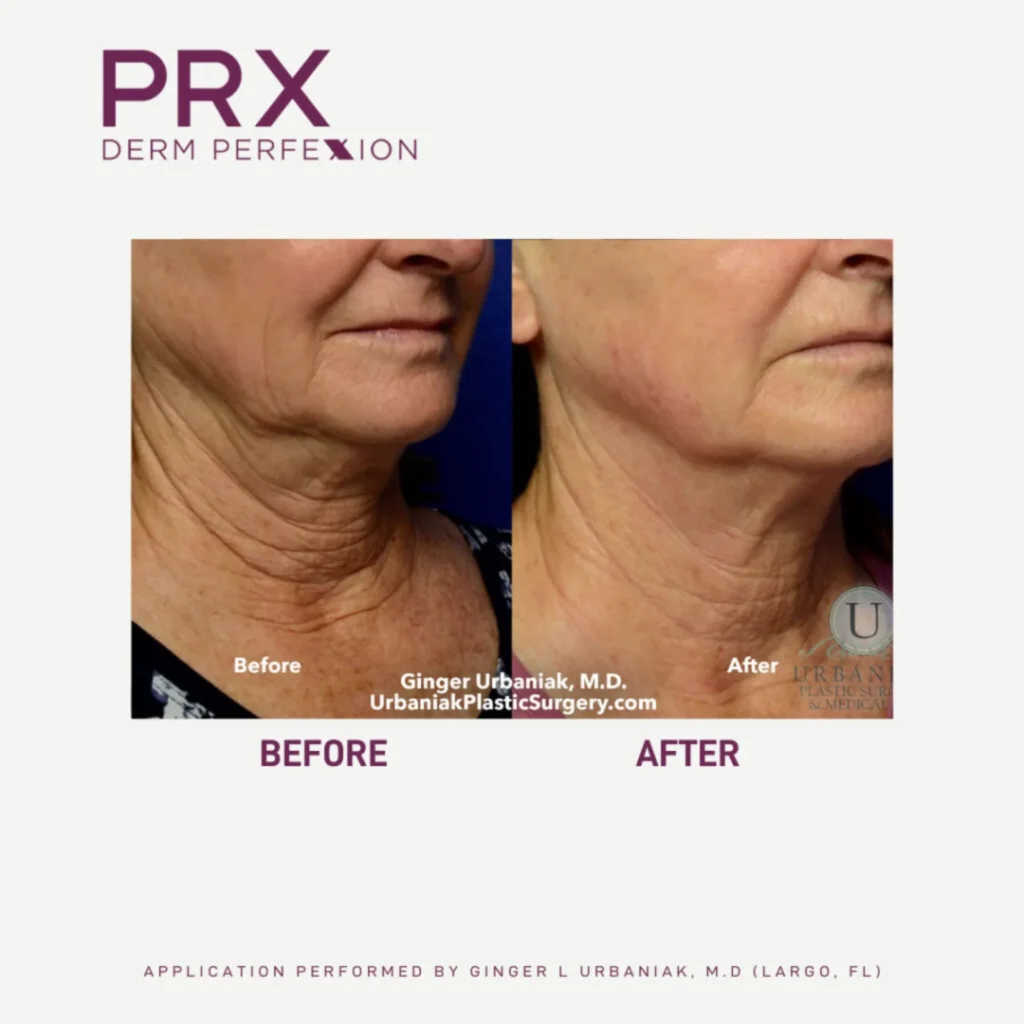 Skin Tightening Park City