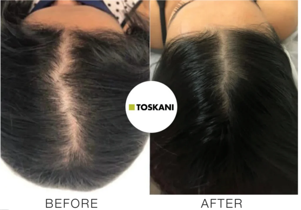 Biorejuvenation Cocktail Mesotherapy