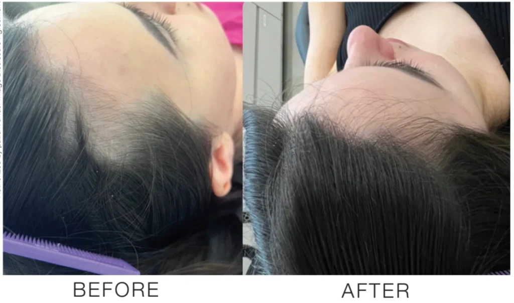 Biorejuvenation Cocktail Mesotherapy