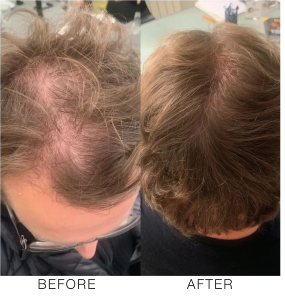 Vampire Hair Restoration