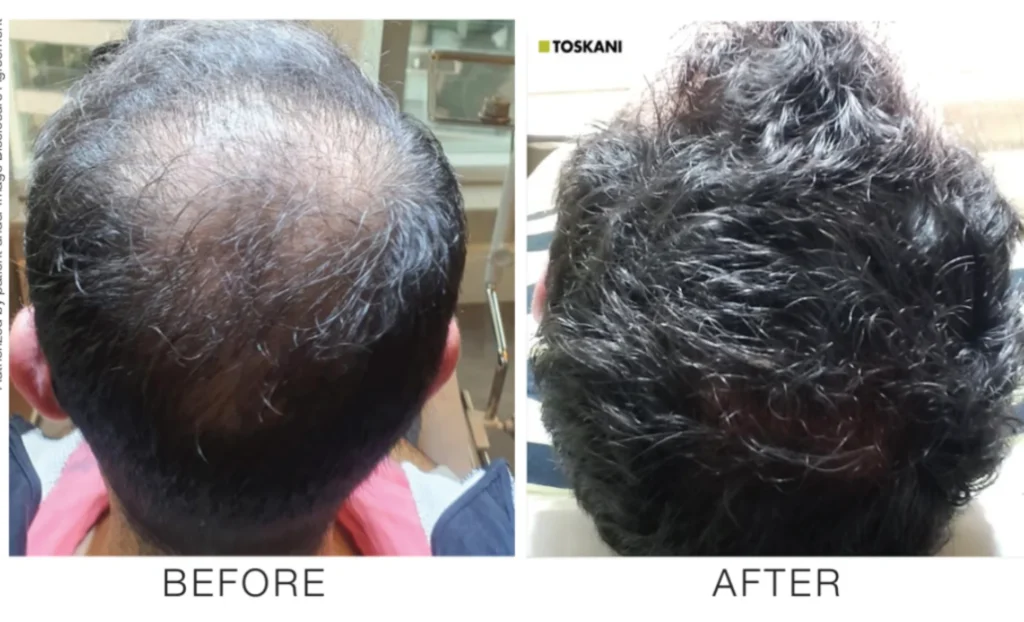 Vampire Hair Restoration